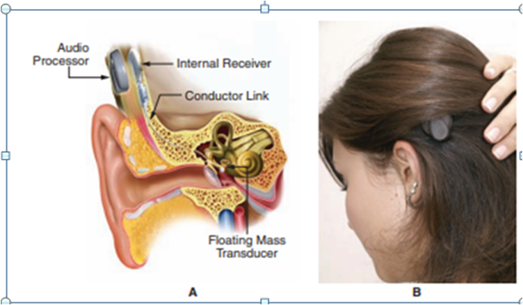 Cochlear Implants 